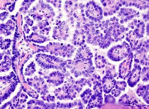 CancerRes：新研究发现帮助清除癌症干细胞的新靶标